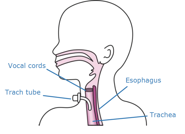 illustration of child with trach tube showing the esophagus, vocal cords, trachea, and tube.